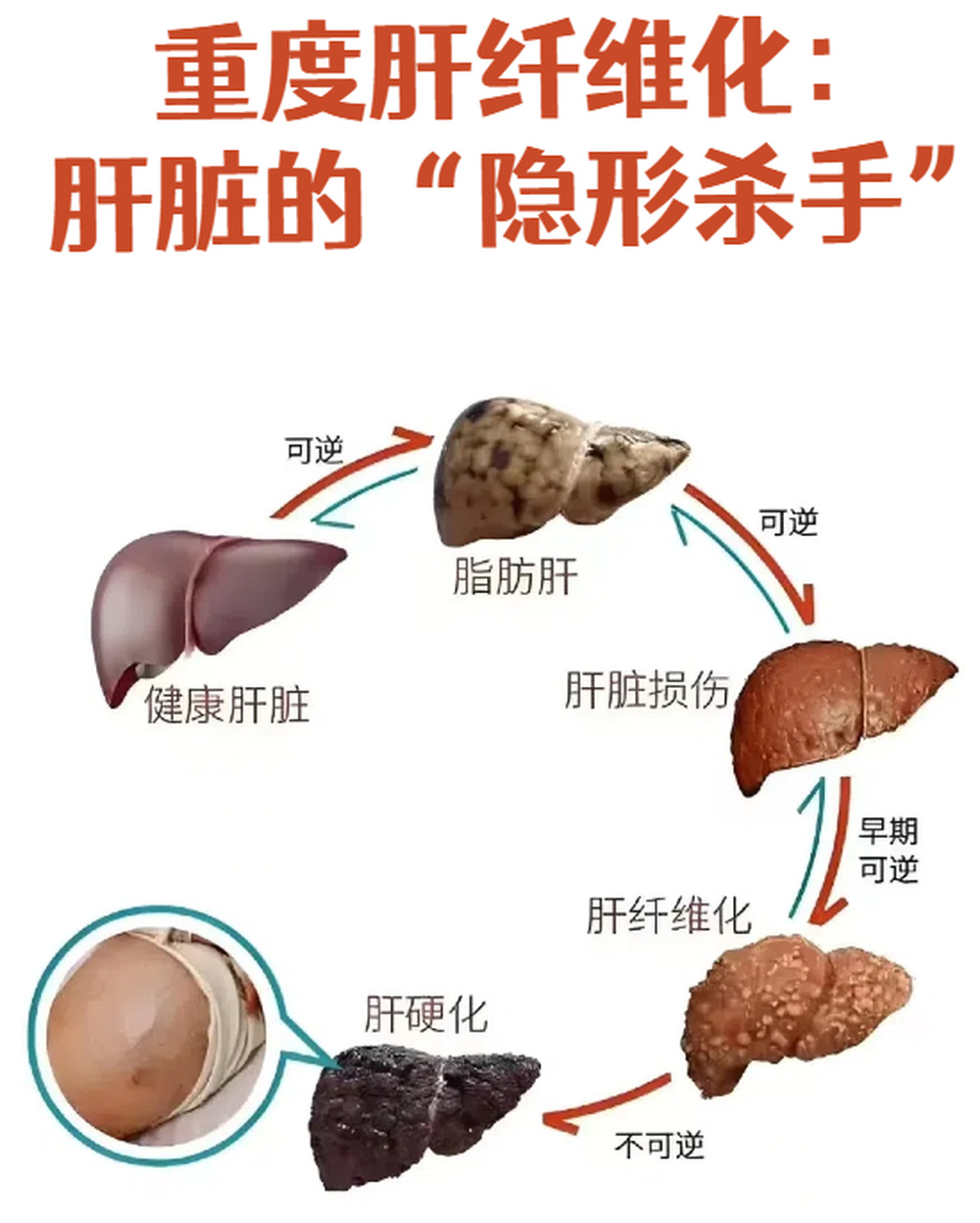 从“草帽姐” 患病说起  一文读懂肝纤维化是个啥 |“医”点就透